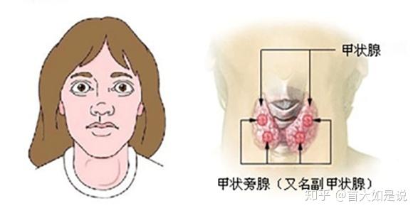 答疑一:我为什么会得甲亢?