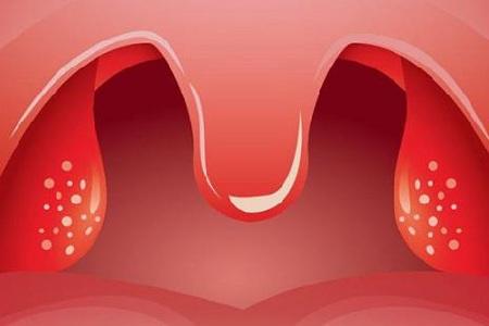 首大石萍如何判斷扁桃體發炎怎麼去預防護理