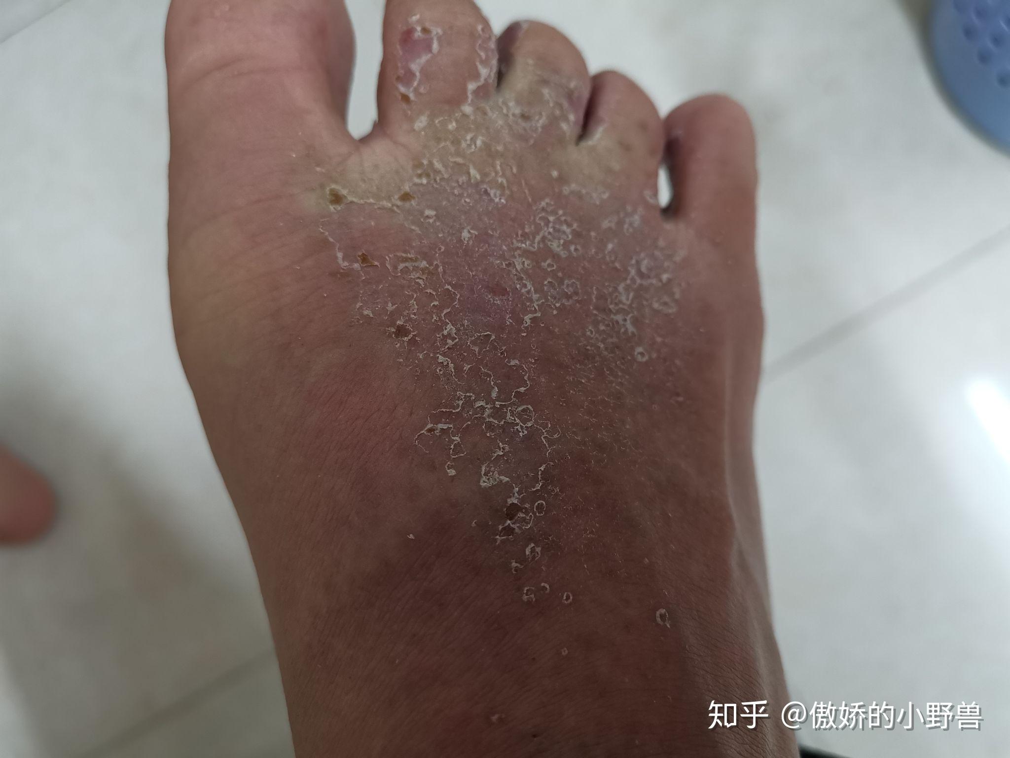 我这个是什么皮肤病 昨晚脚背开始是白色小痘痘 早上的时候就红色了 脚背痒 手背的不痒 背部也有！_百度知道