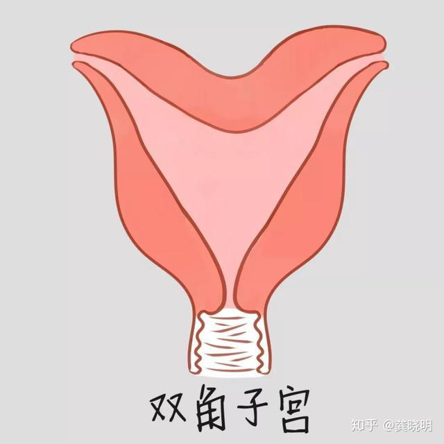 子宫畸形的三种情况：纵膈子宫、双角子宫和双子宫 - 知乎
