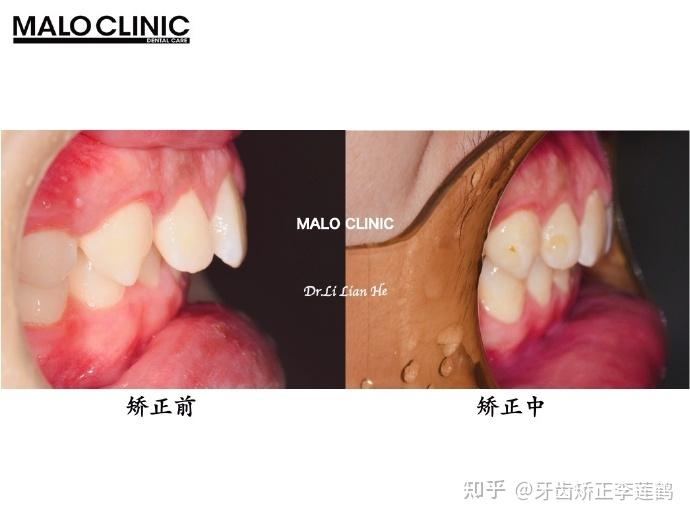 北京牙齒矯正丨深覆合深覆蓋有什麼危害