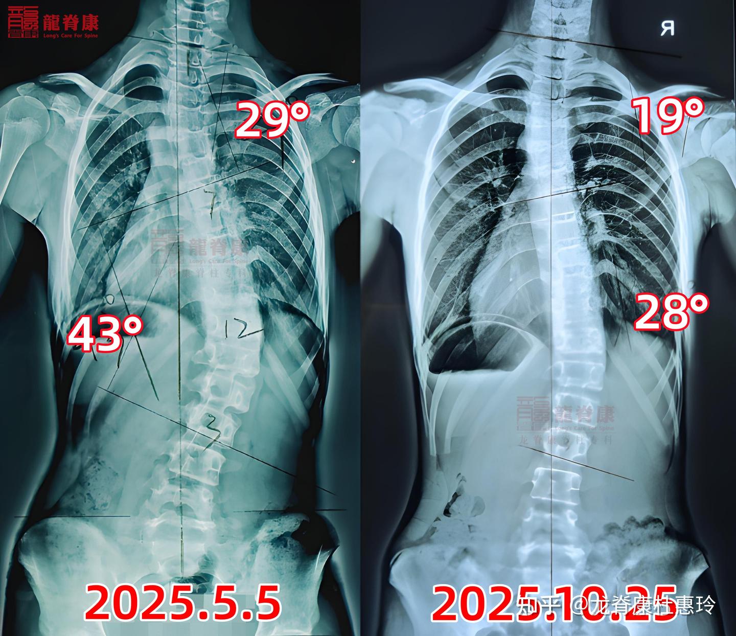 从43°到28°!13岁女孩的脊柱侧弯逆袭记,每一度都是希望 - 知乎