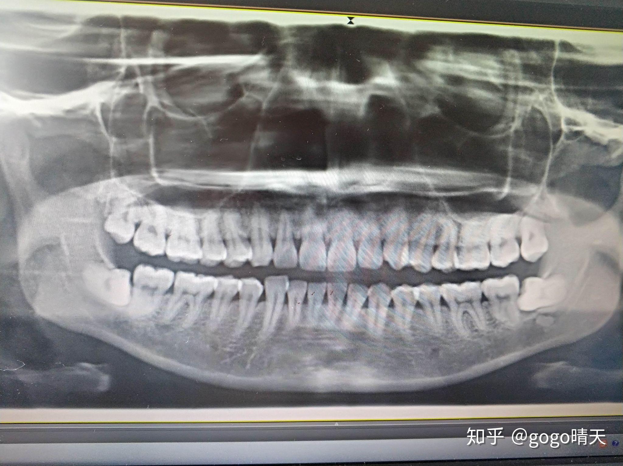 可以拍个口腔全景片,拍了才发现下面长了两个埋伏型阻生智齿,但是一点
