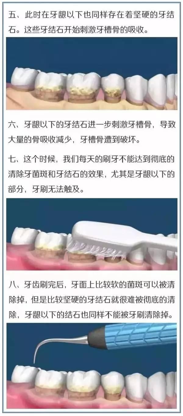 有了这张图，洗牙过程一目了然 知乎 