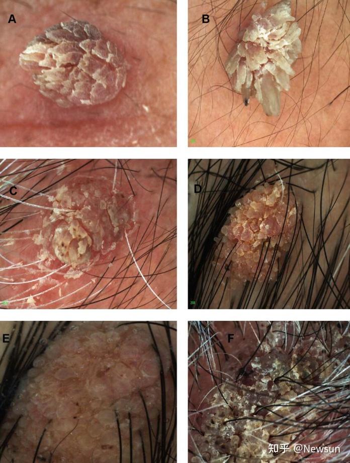 身上5种疣可能是hpv感染