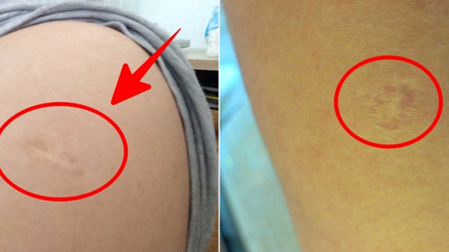 江苏校园结核爆发我们都打了卡介苗了么为什么还会得病呢