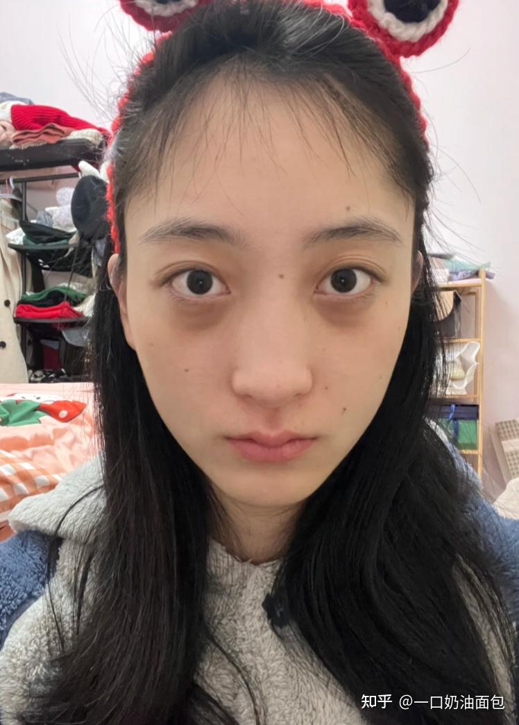 女生气血不足,黑眼圈重怎么快速改善?