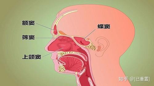 孙国政医生耳鼻喉健康:上颌窦炎有哪些疾病类型?