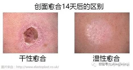 日常跌撞磕碰,伤口怎么处理才能好得快!不留疤! - 知乎