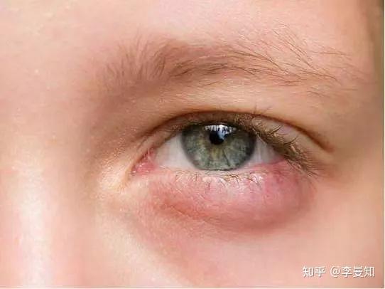 浮肿眼袋3.解决方
