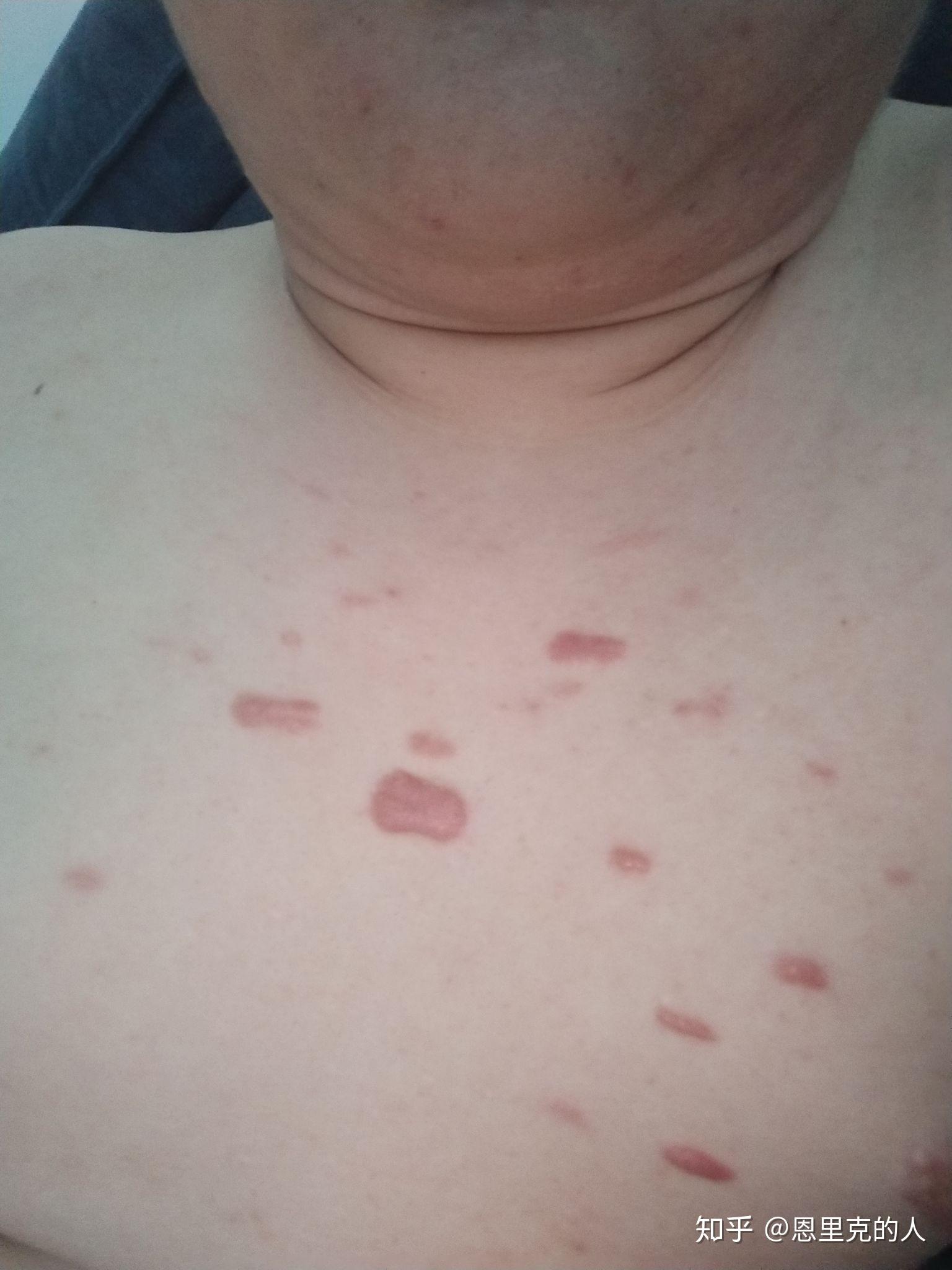 疤痕疙瘩做同位素锶90放疗会一直更新