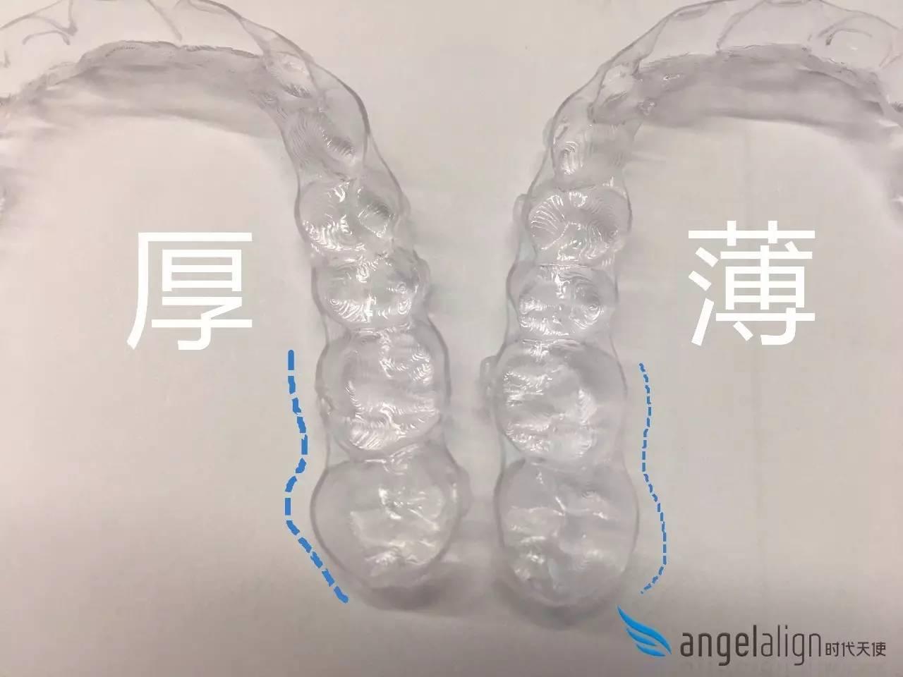 戴时代天使隐形牙套是一种什么样的体验？ - 知乎