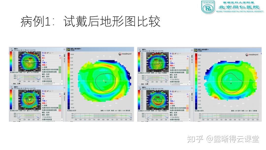 角膜地形图解读及露晰得塑形镜验配要点（文字版） - 知乎