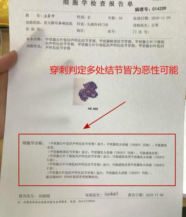 检查出甲状腺结节年 拖到甲癌淋巴全部转移 包块已经长到颈后 知乎