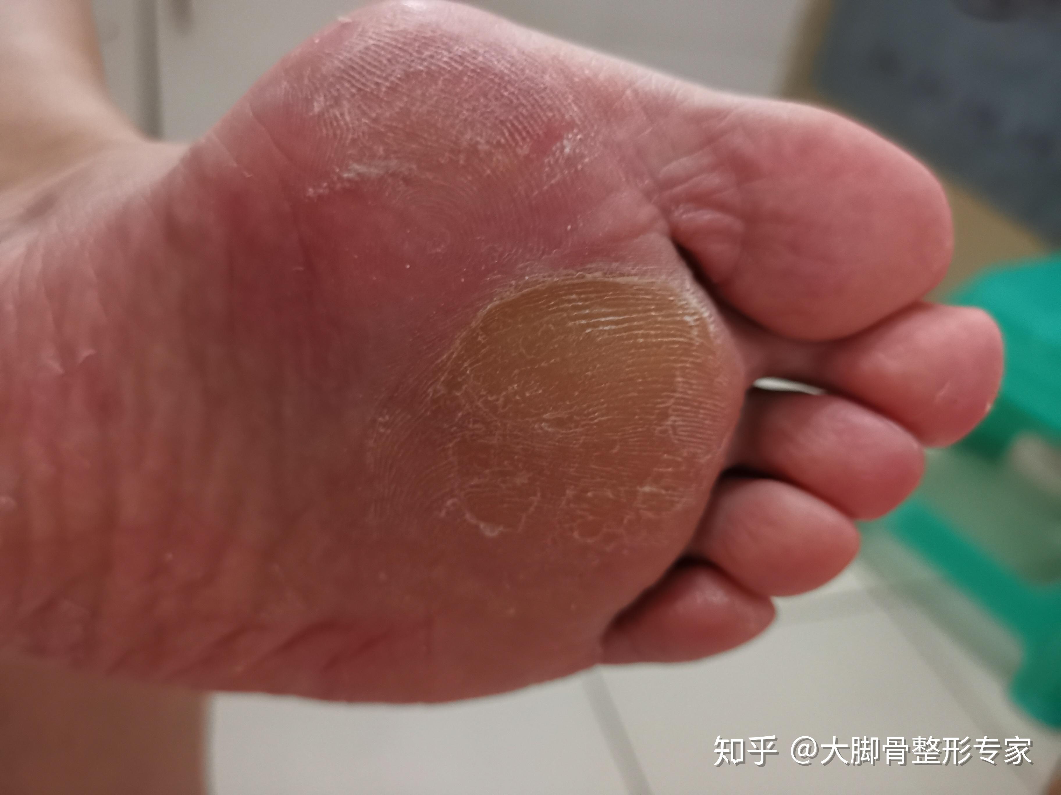 大脚骨医生解释 - 知乎