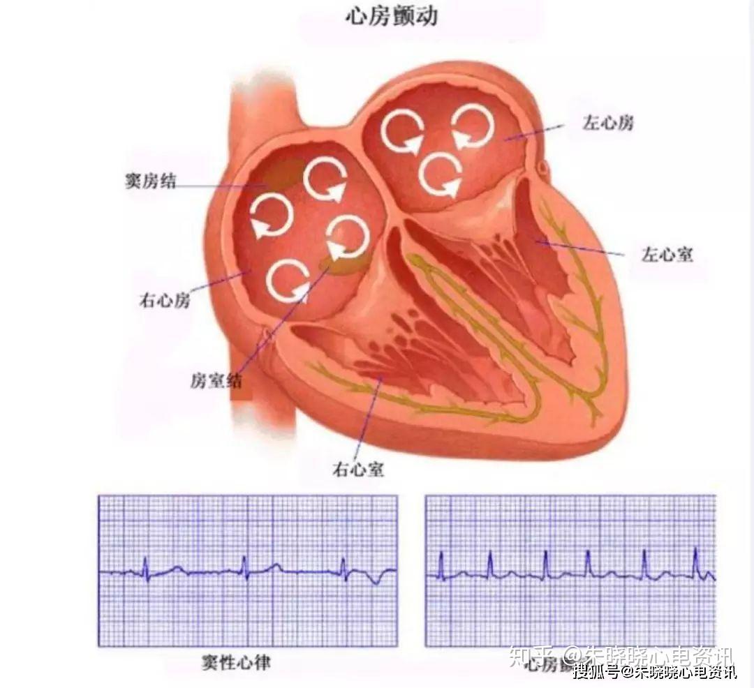例6.心房颤动伴A型预激(图3-9～3-11)-心血管-医学