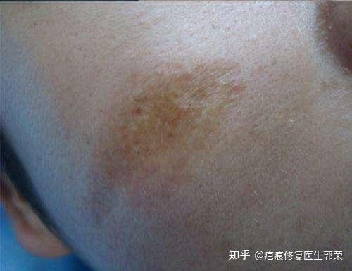 导致伤口愈合过程中,表面颜色变深,形成色素沉着疤痕