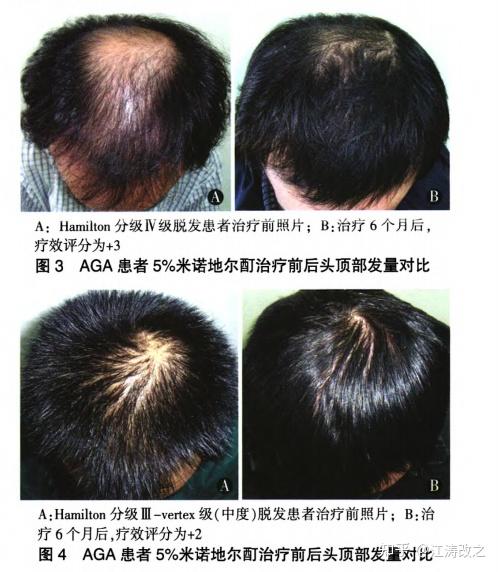米诺地尔实际治疗脱发效果观察