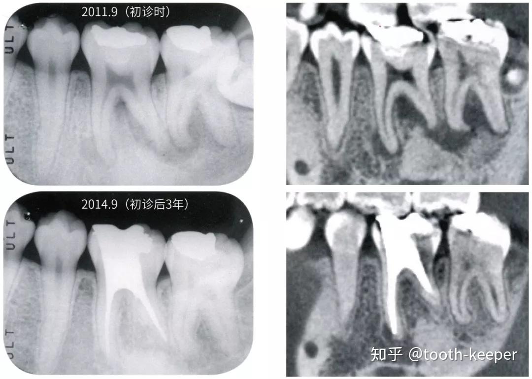 没有病理性牙周袋的磨牙区死髓牙会在根分叉部呈现出透明区域,根分叉