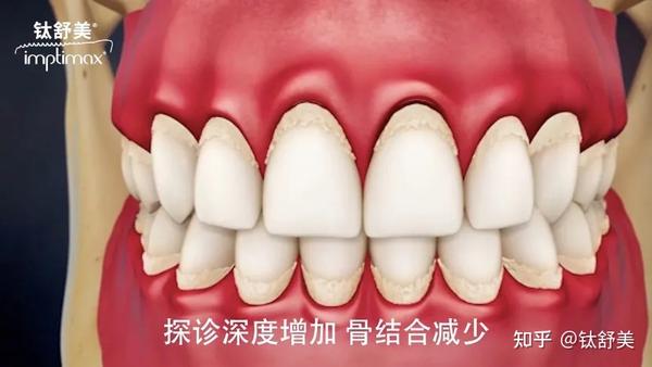 牙龈炎如何演化成牙周炎 - 知乎
