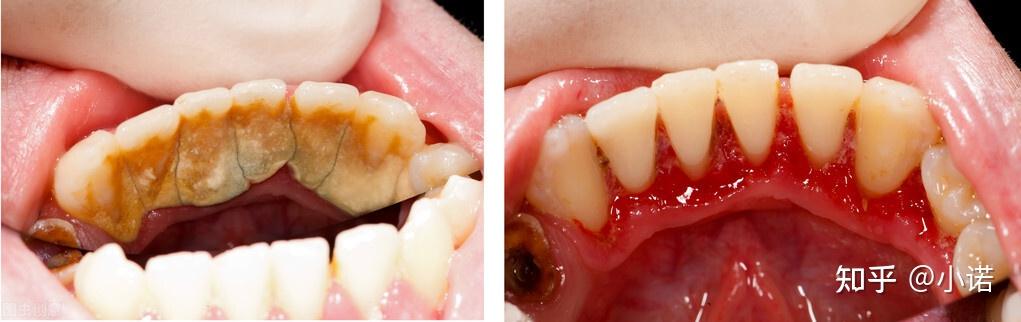 牙结石有两种:牙龈上结石和牙龈下结石.