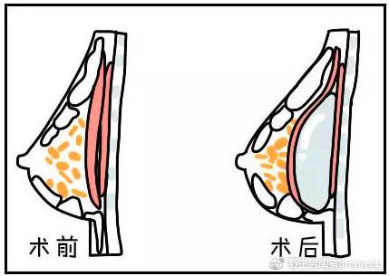 隆胸分為假體隆胸和自體脂肪隆胸.