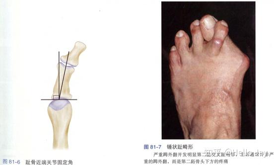 拇外翻的手术治疗 - 知乎