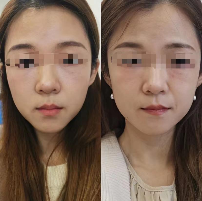 热玛吉超声炮和7d聚拉提有什么区别怎么选择适合自己的仪器价格多少
