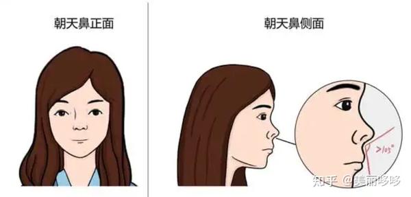 隆鼻干货分享,如何选择适合的鼻模板?隆鼻方式优缺点分享 - 知乎