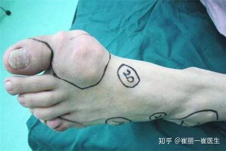 破伤风发作了再打可以吗 v2-c6cf0aa9a78bc658a51b65c3e3760abf_r.jpg