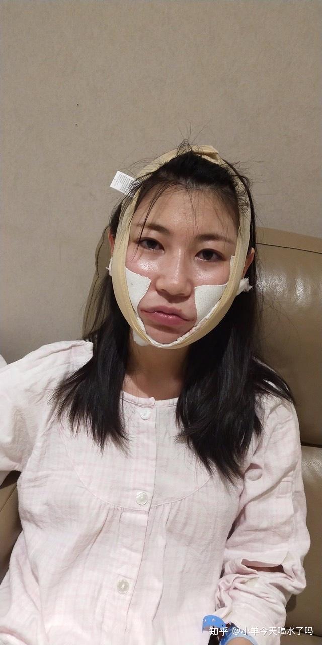 没想到面部吸脂后的效果可以这么好