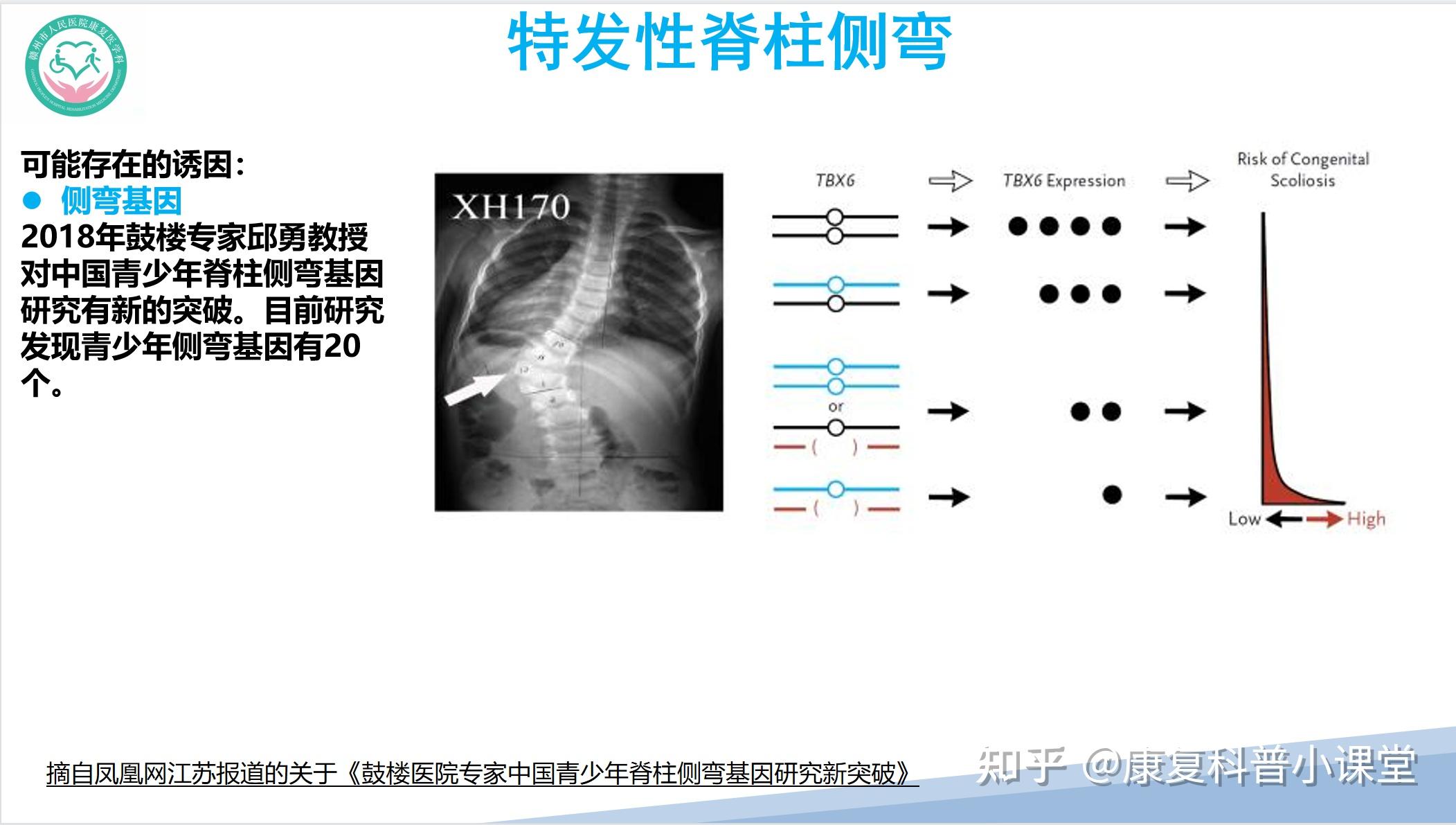 特發性脊柱側彎的診療策略