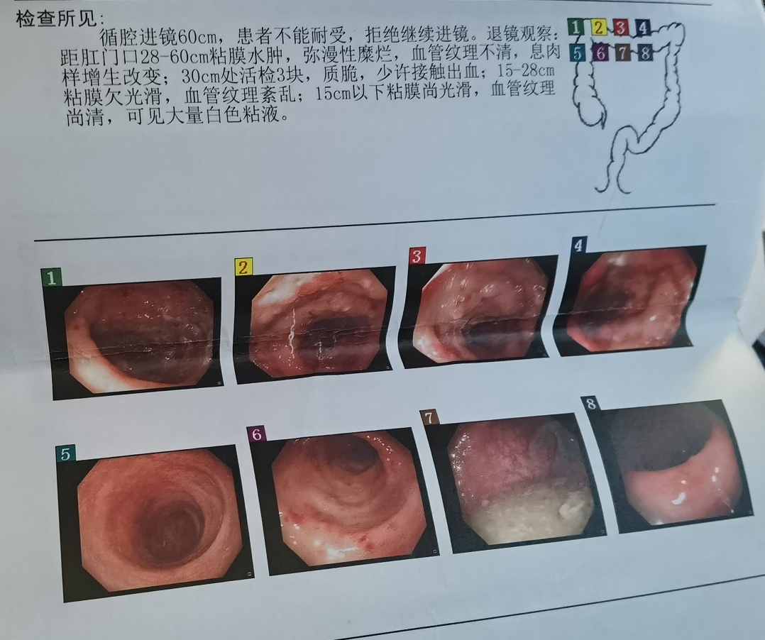 的時候,突然就復發了,去北醫三院掛了個號,因為疫情原因不能做腸鏡,給