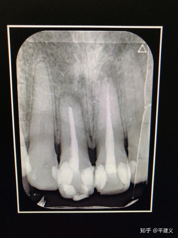 反反复复的慢性根尖周炎治牙之路