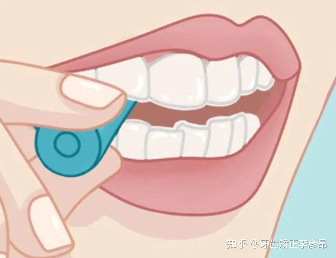 隐形牙套的应急指南