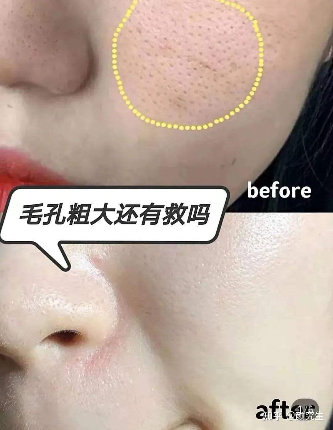 光子嫩肤能维持多久光子嫩肤需要做几次