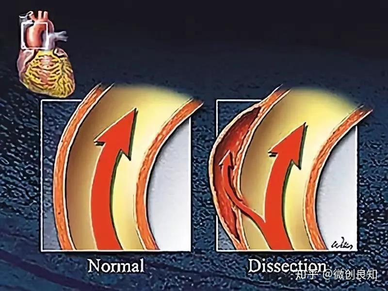 主动脉夹层,藏在动脉血管里的不定时炸弹 - 知乎