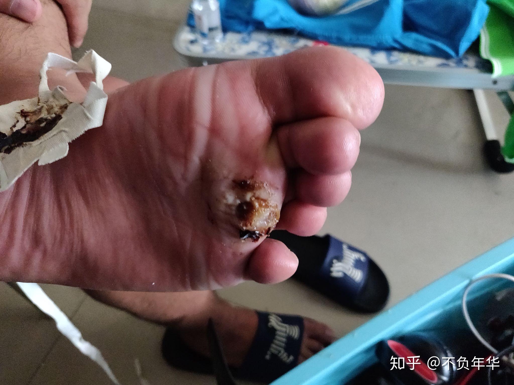 趾疣斗争史 - 知乎