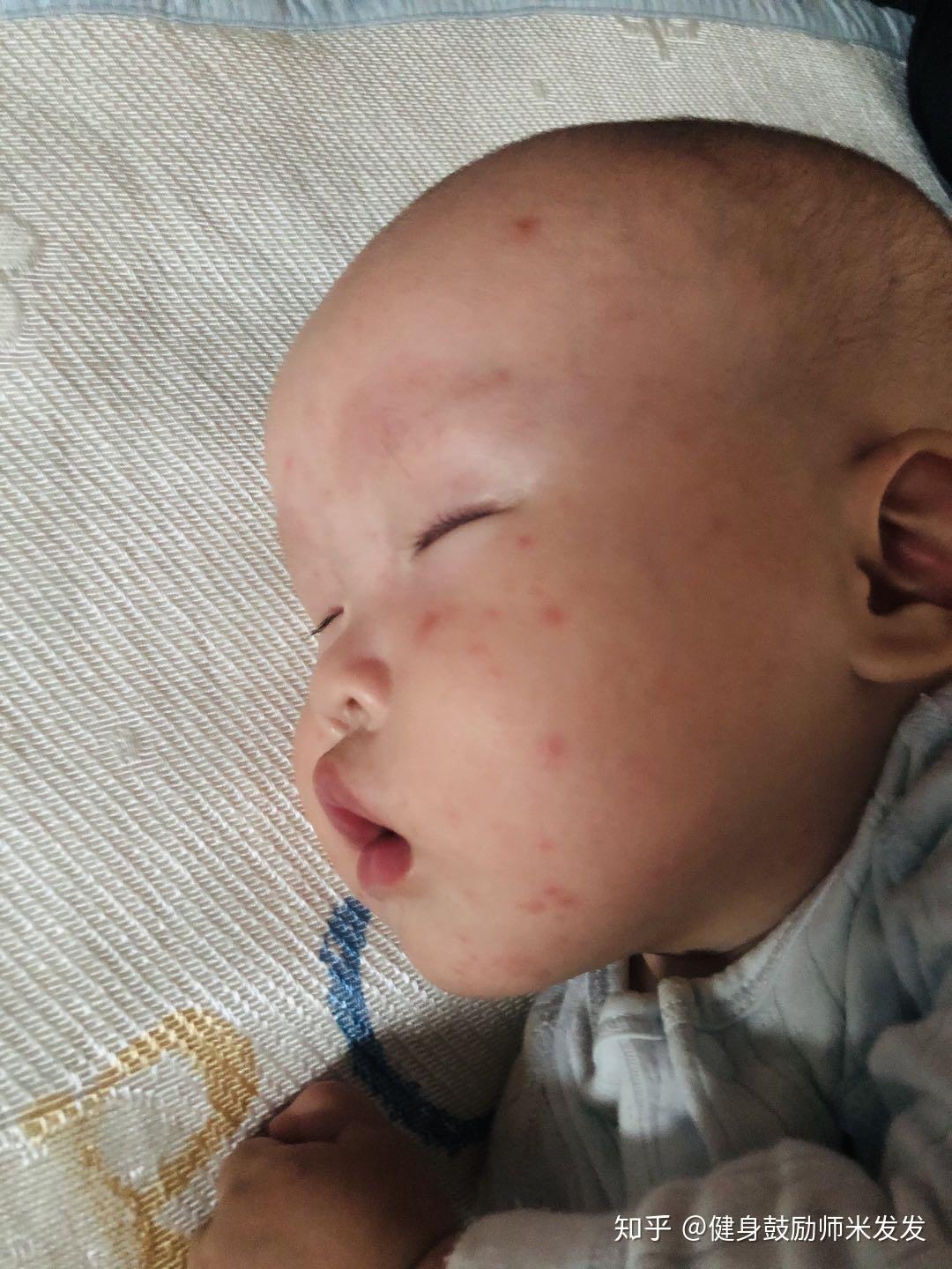 脸上长红疱疹的图片,宝宝脸上有块红的图片_大山谷图库