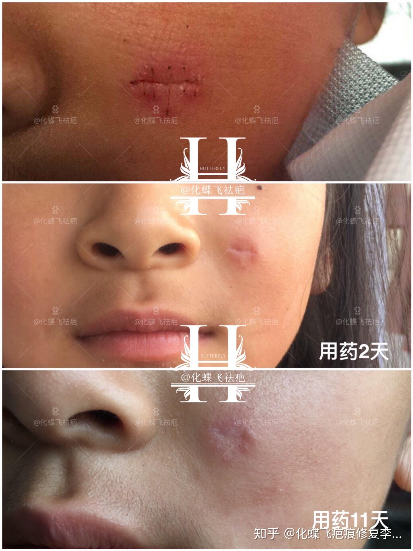 外伤缝合5针,涂中药11天,效果奇好 - 知乎