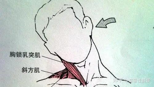《痉挛性斜颈:生命中的坚韧挑战》 - 知乎