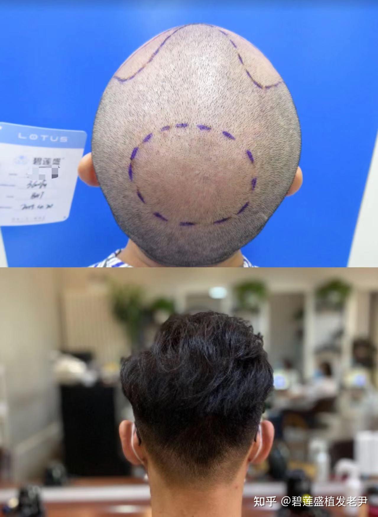 大家如果有脱发,植发方面的问题,或者想查看植发10年以上的效果案例