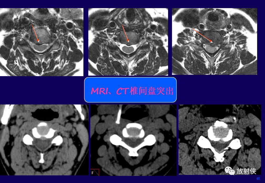 神内临床笔记53 颈椎病影像学表现