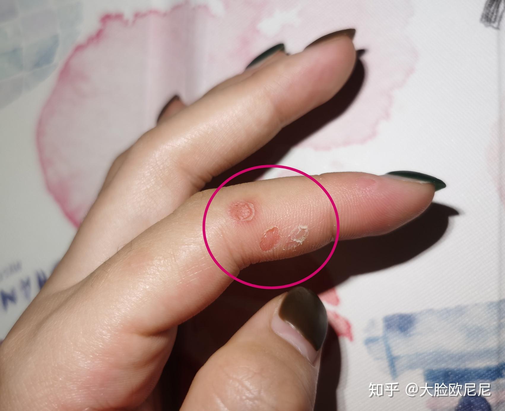 手痒挠了以后会起皮撕破后会疼这是皮肤病嘛