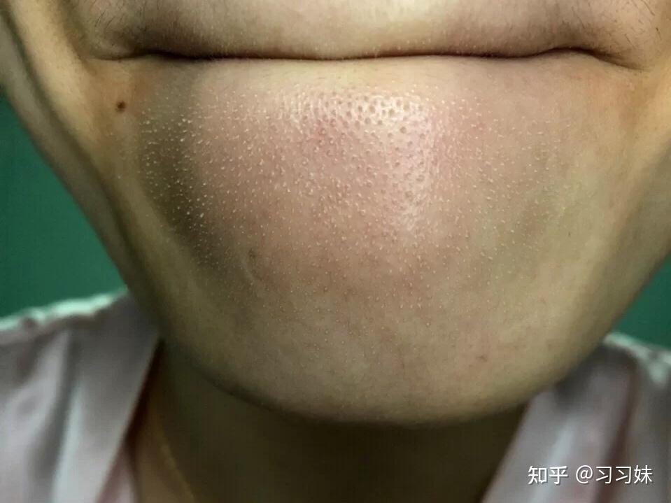 荷荷巴油真的能去黑头吗