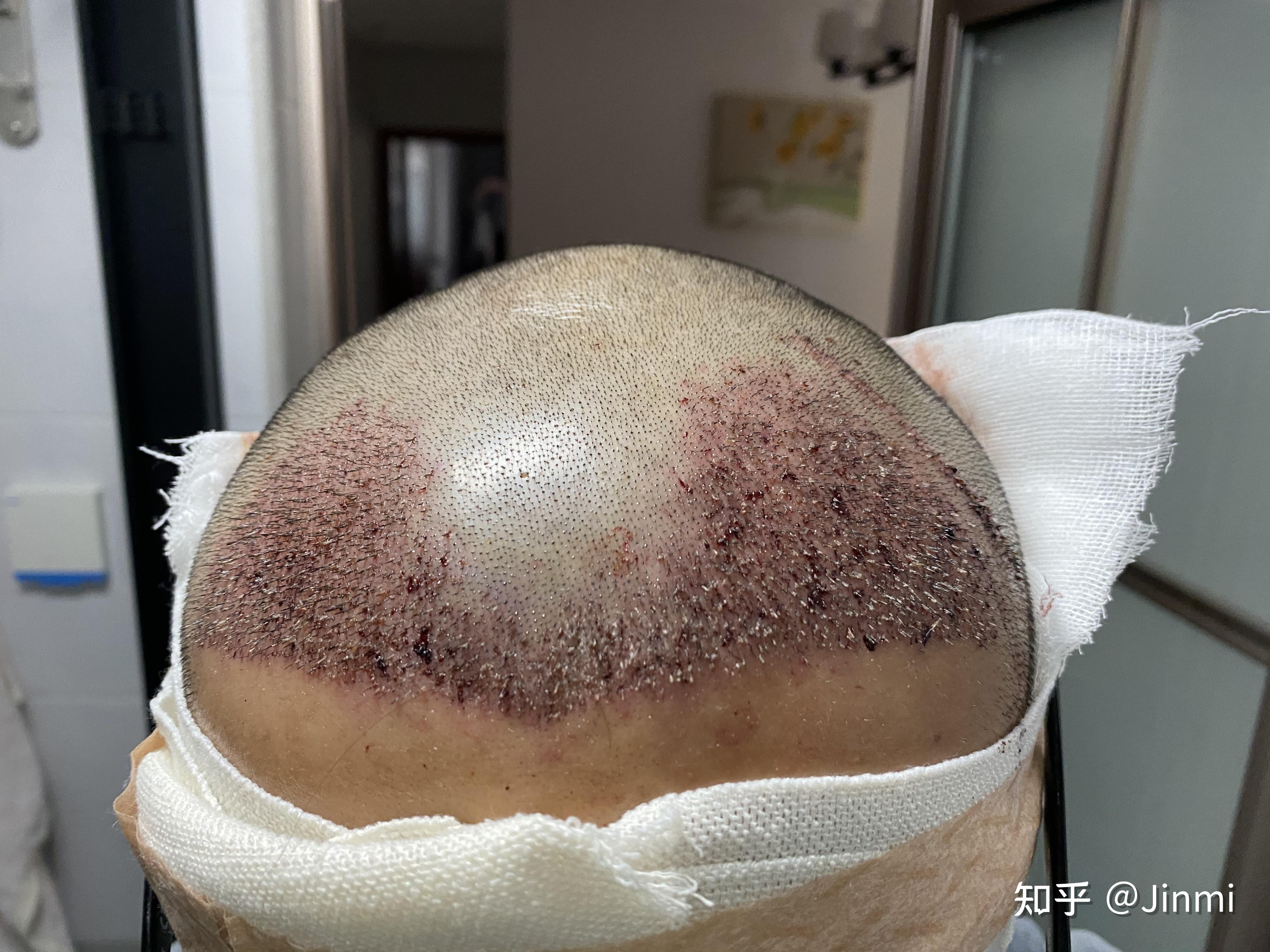 植发区肿胀感(植发的肿胀要多久消除)