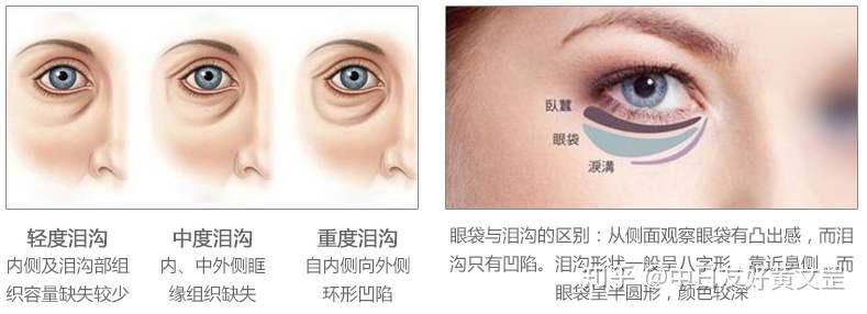 有了泪沟太显老?3种方法教你摆平泪沟 - 知乎