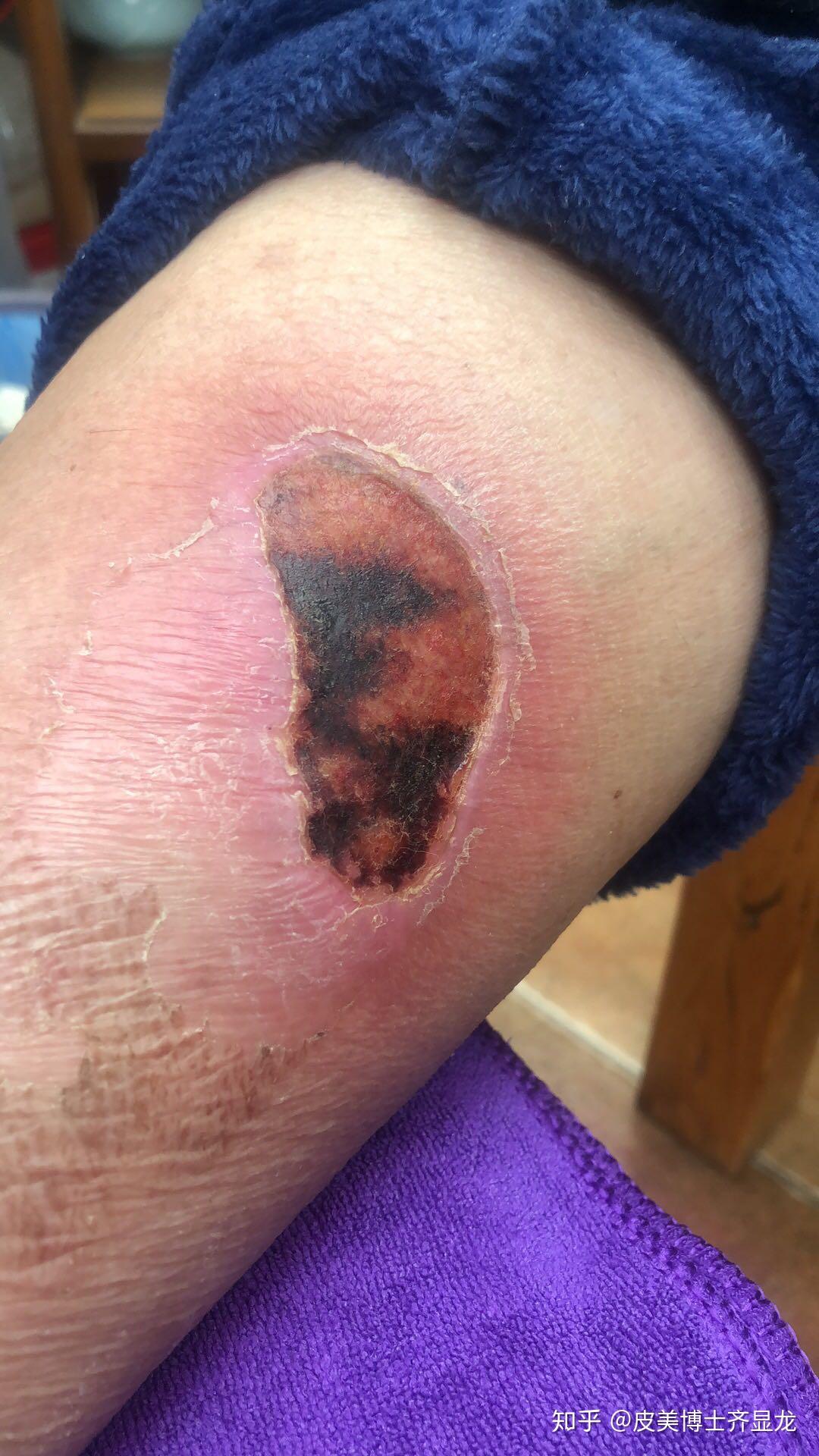 一位小姑娘的烫伤求助史