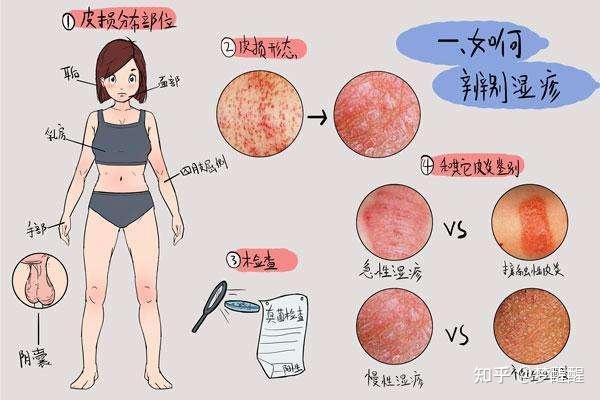 判断自己是否得了湿疹，多注意这四点，湿疹好的快！湿疹的症状是什么？