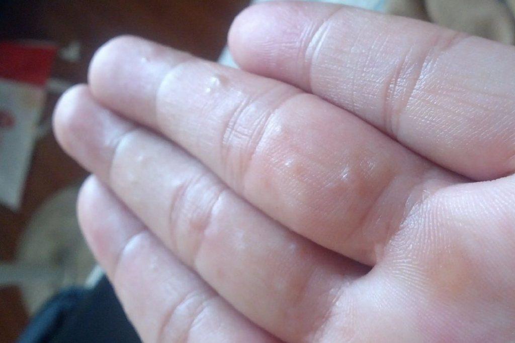 夏天手上长透明小水泡,是汗疱疹吗?怎么办? - 知乎